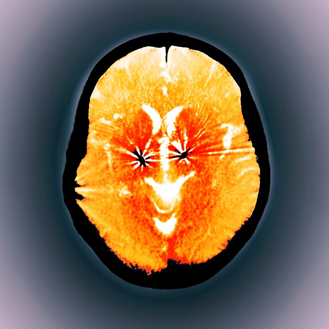 Parkinson's brain pacemaker,CT scan