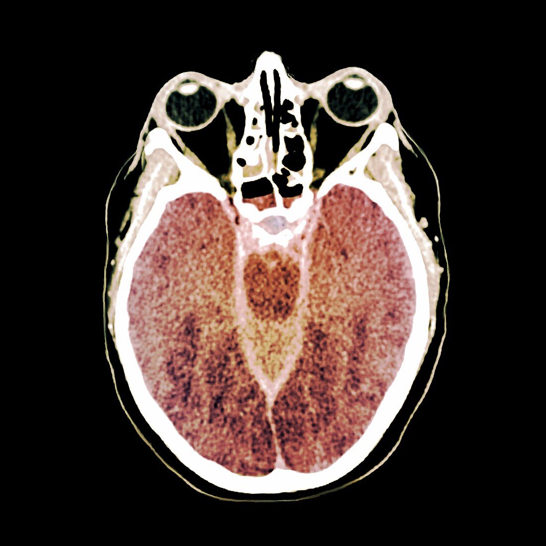 Brain death following cardiac arrest,CT