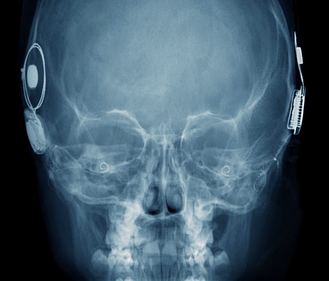 Cochlear implants,X-ray