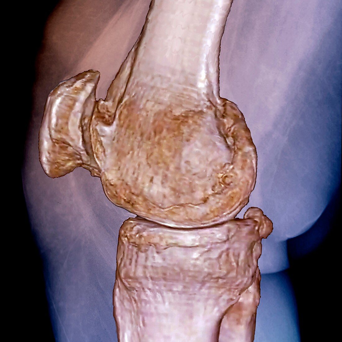 Knee in osteoarthritis,3D CT