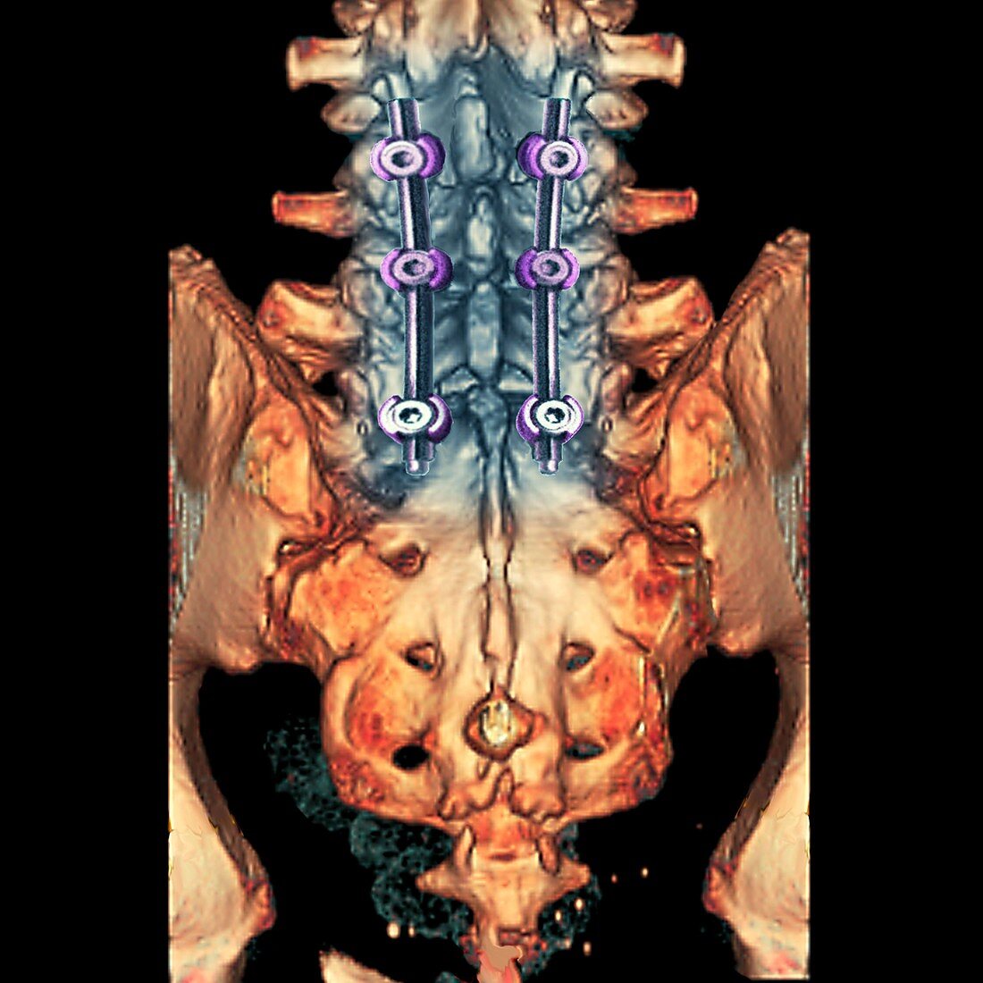 Fixed spinal fracture,3D CT scan
