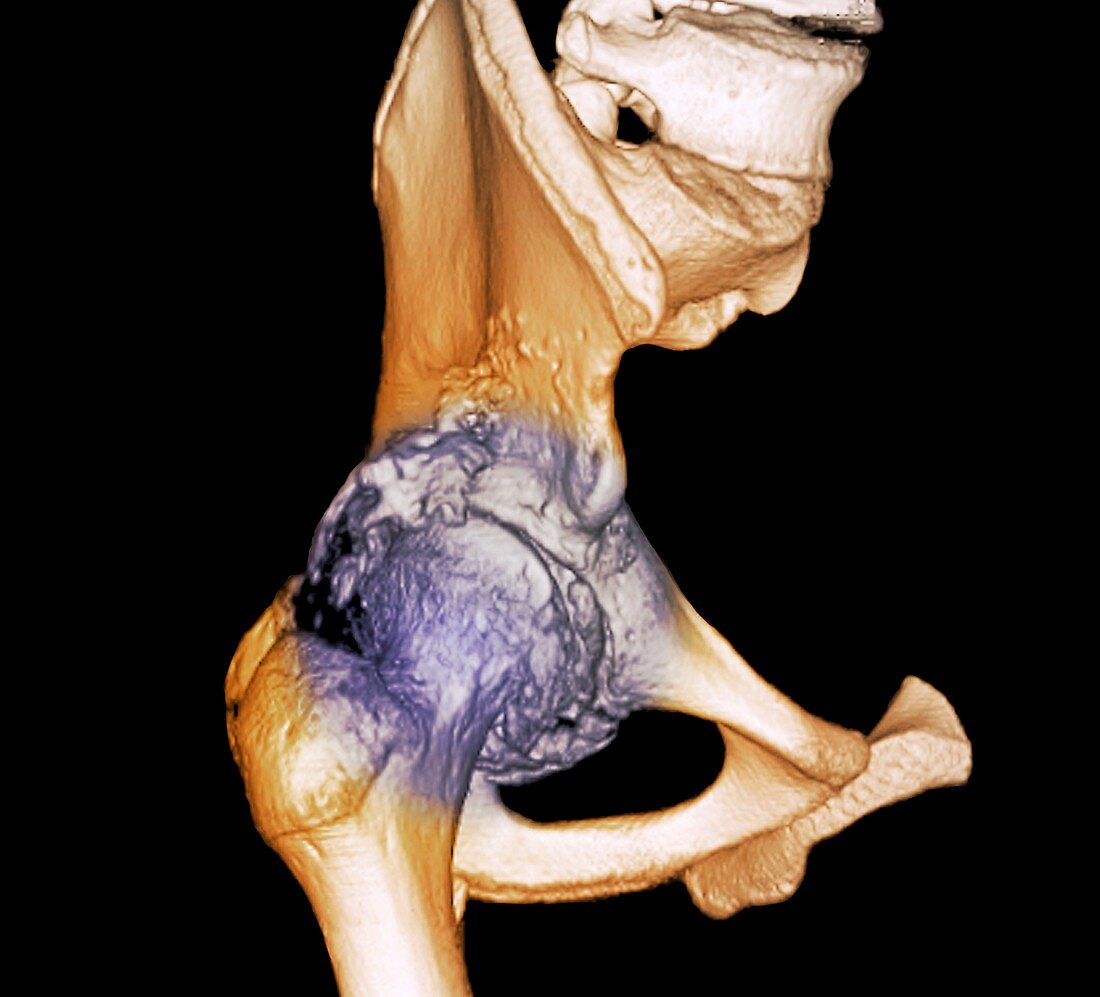 Osteoarthritis of the hip,3D CT scan