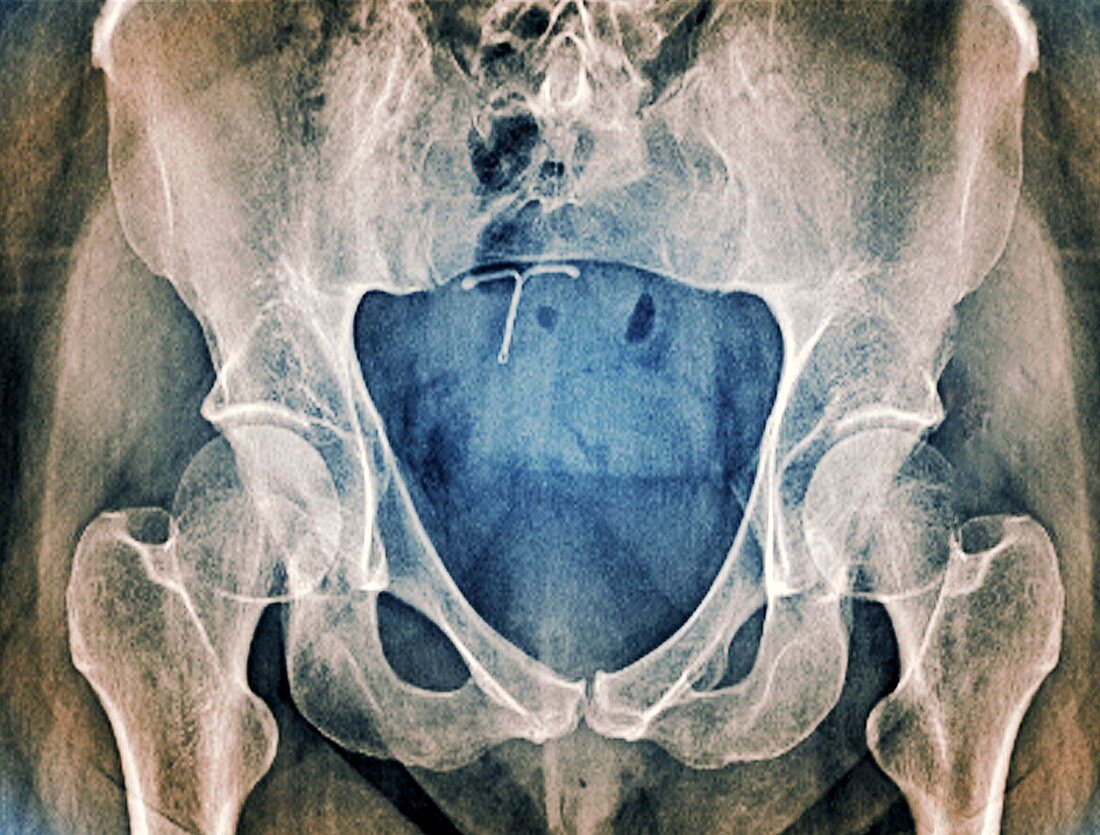 Underdeveloped pelvic bones,X-ray