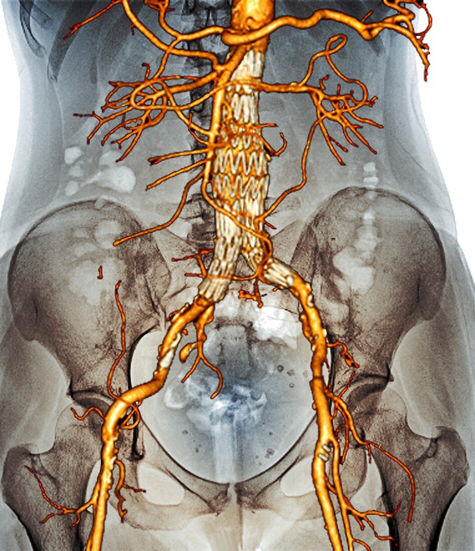 Stent in carotid aneurysm,3D CT scan