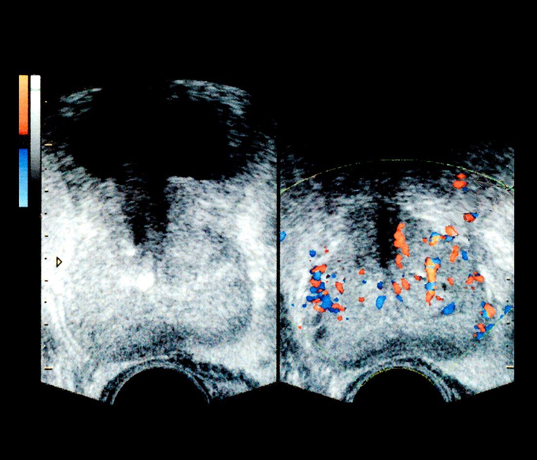 Enlarged prostate,ultrasound
