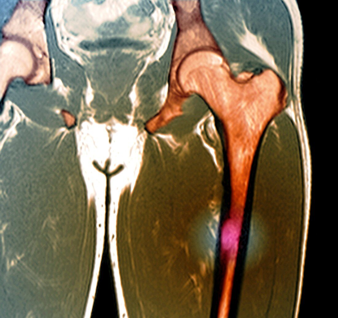 Hip in Langerhans cell histiocytosis,MRI