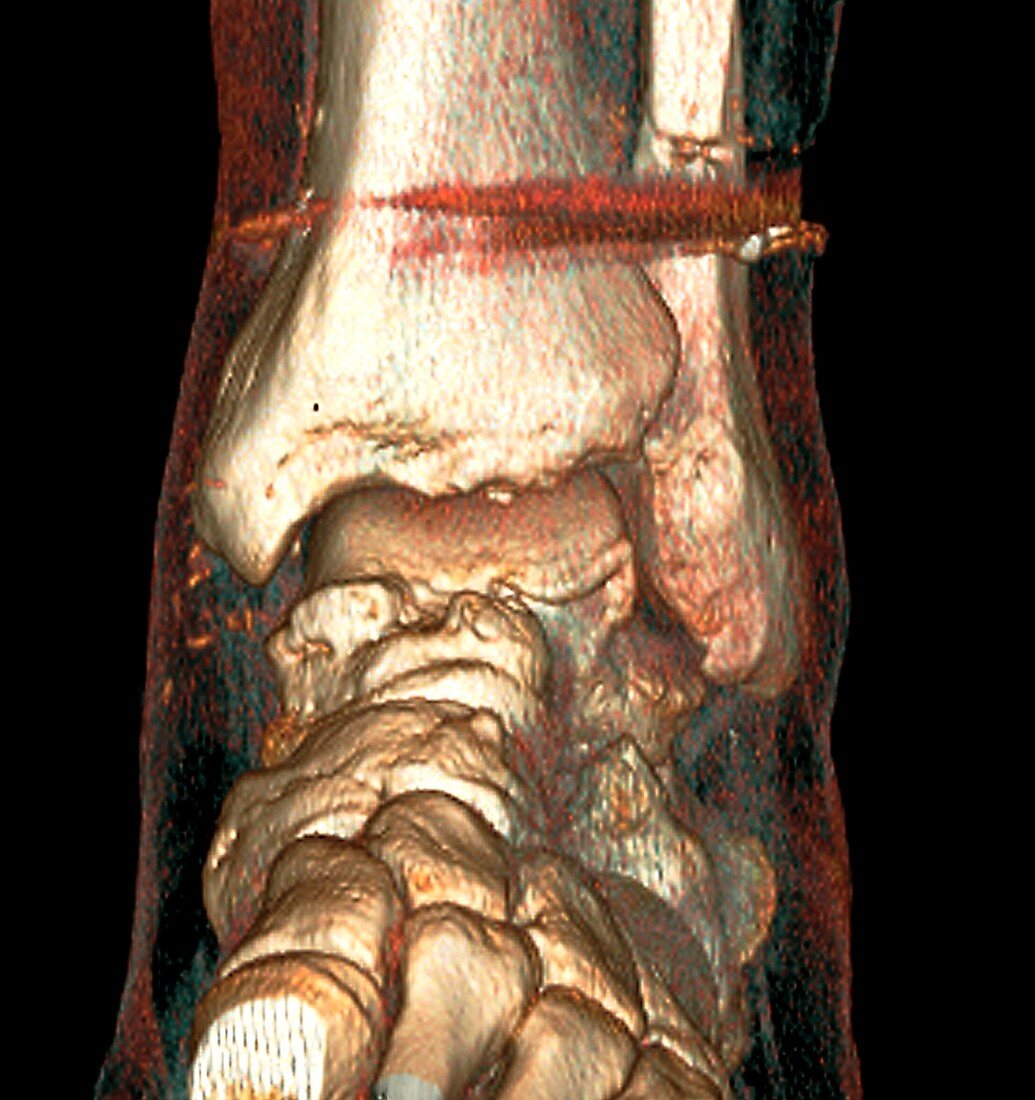 Fixed broken leg,3D CT scan