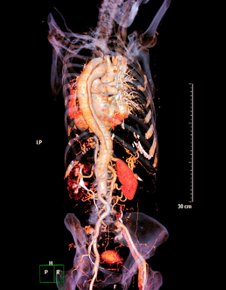 Arterial dissection,3D CT scan