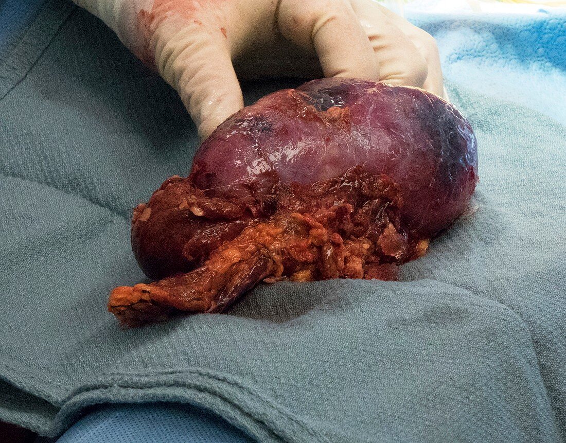 Failed kidney transplant
