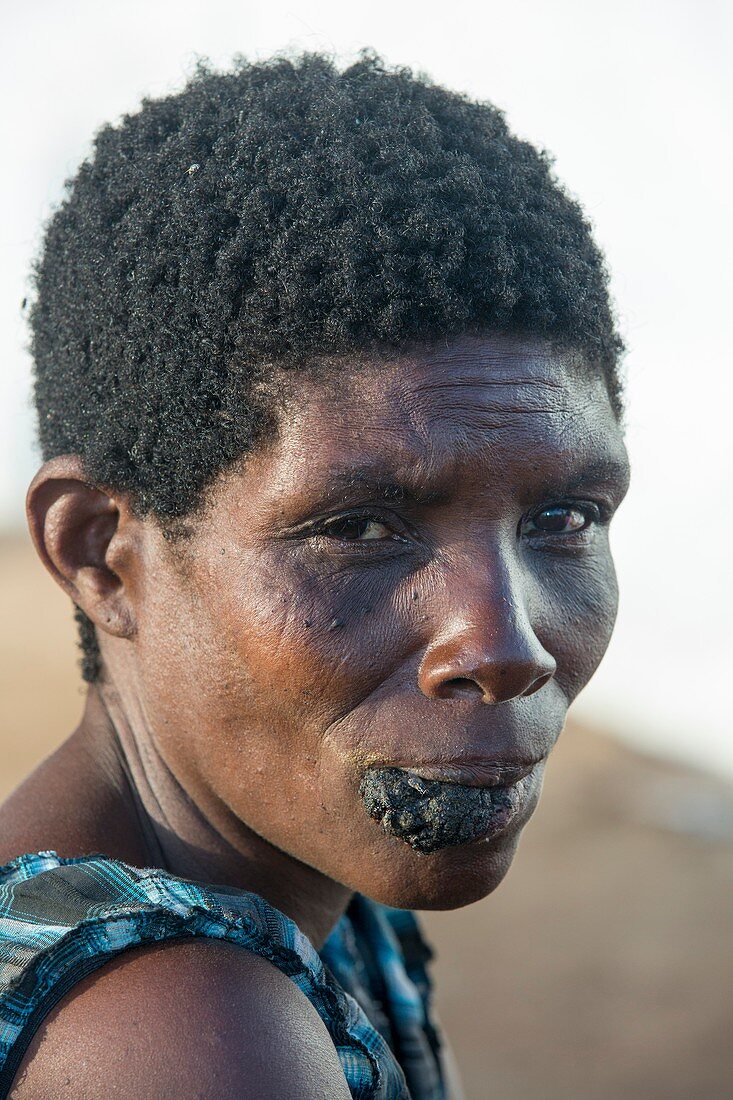 Refugee with facial tumour
