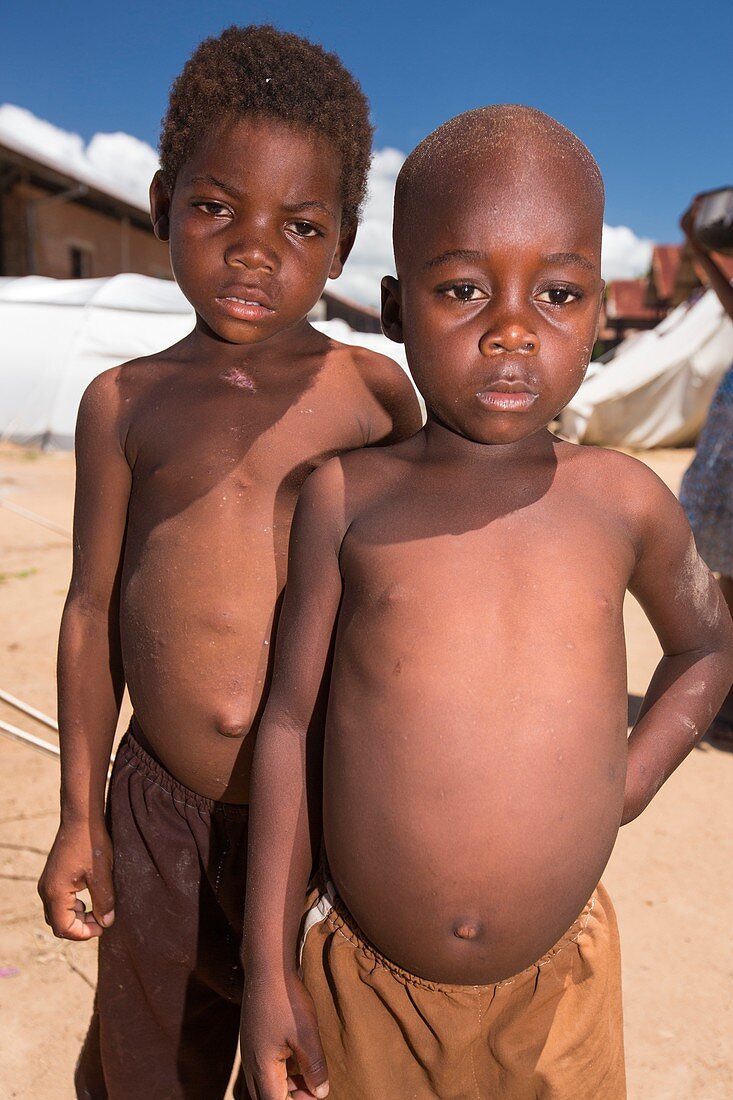Malnourished refugee children,Malawi