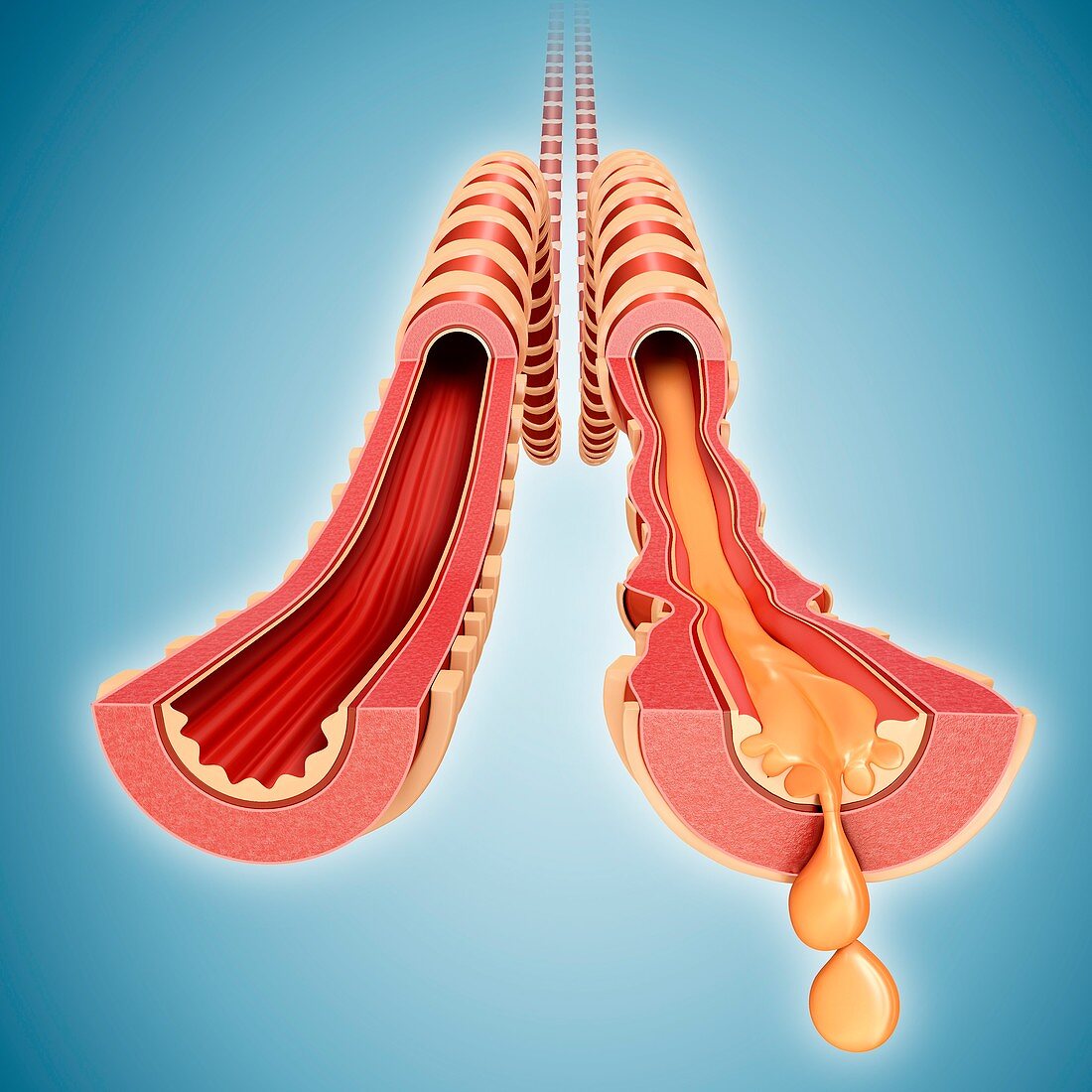 Infected human bronchus,illustration