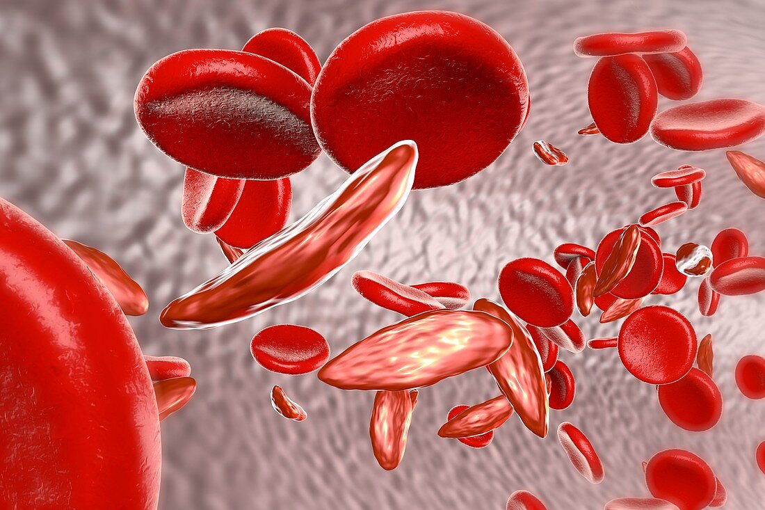 Sickle cell anaemia,illustration