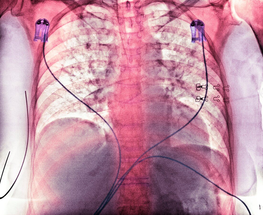 Aspiration,chest X-ray