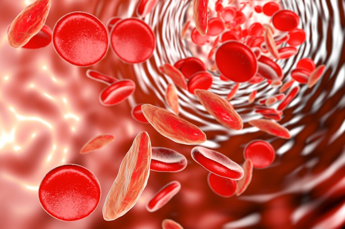 Sickle cell anaemia,illustration