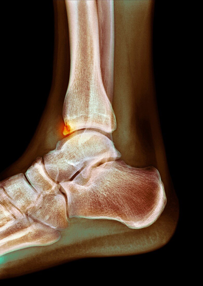 Tibial spur,X-ray