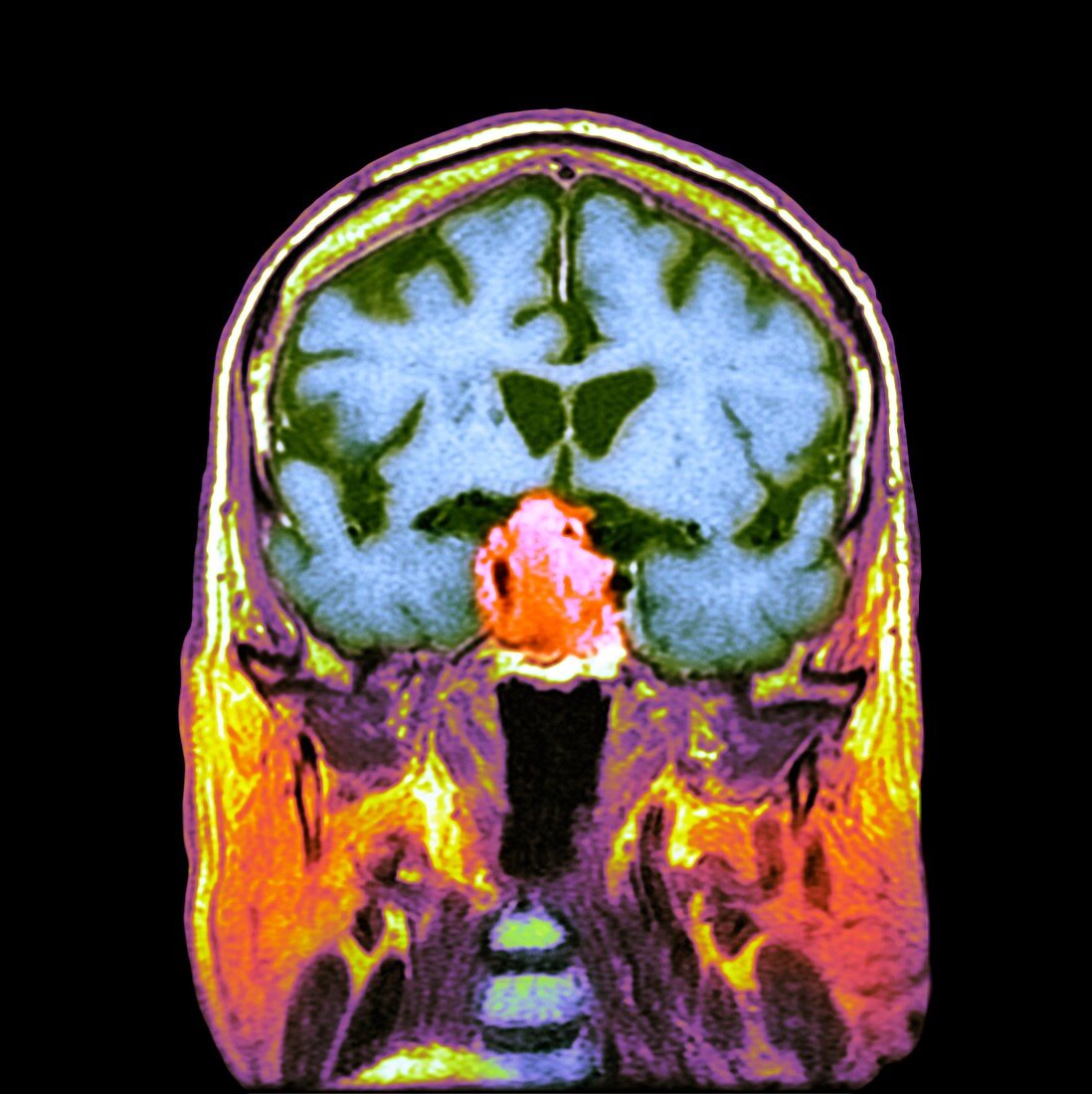 Pituitary tumour,CT scan