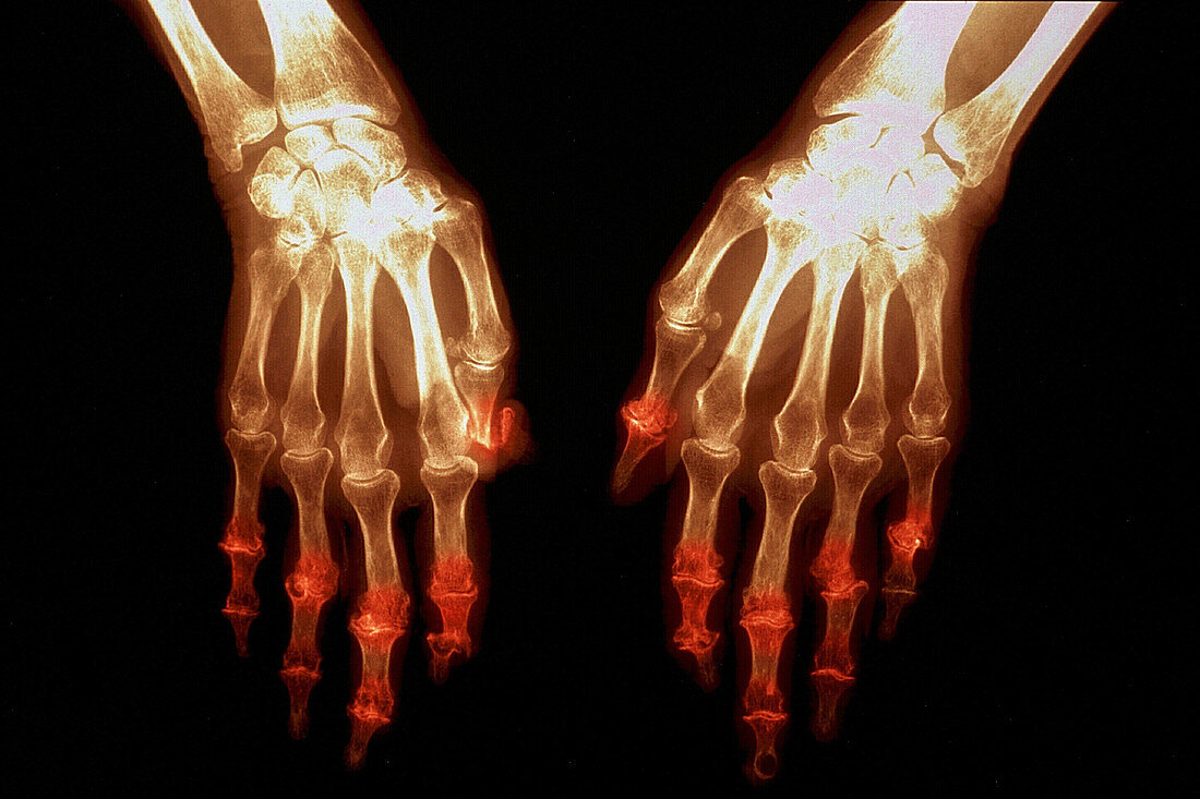 Arthritis, X-ray