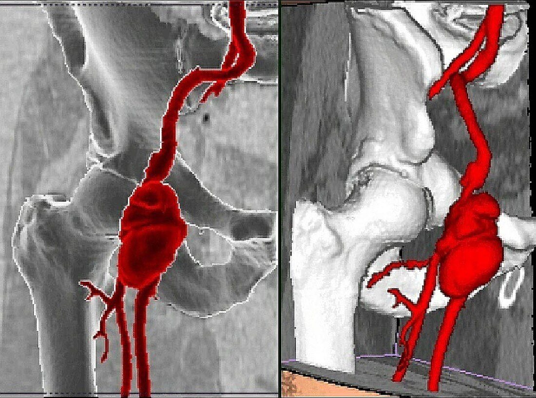 Right femoral infectious aneurysm, CT scan