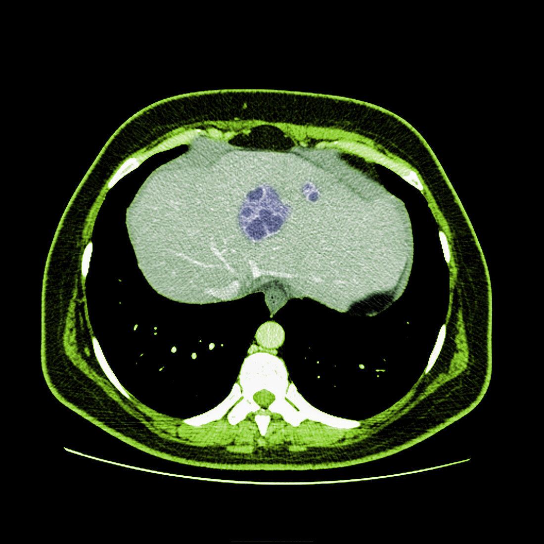 Liver abscess, CT scan