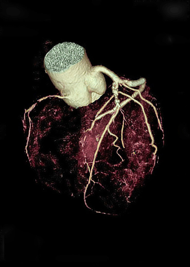 Stenosis of coronary arteries, CT scan