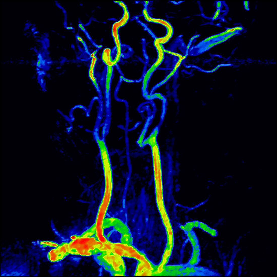 Supra-aortic trunks, MRI