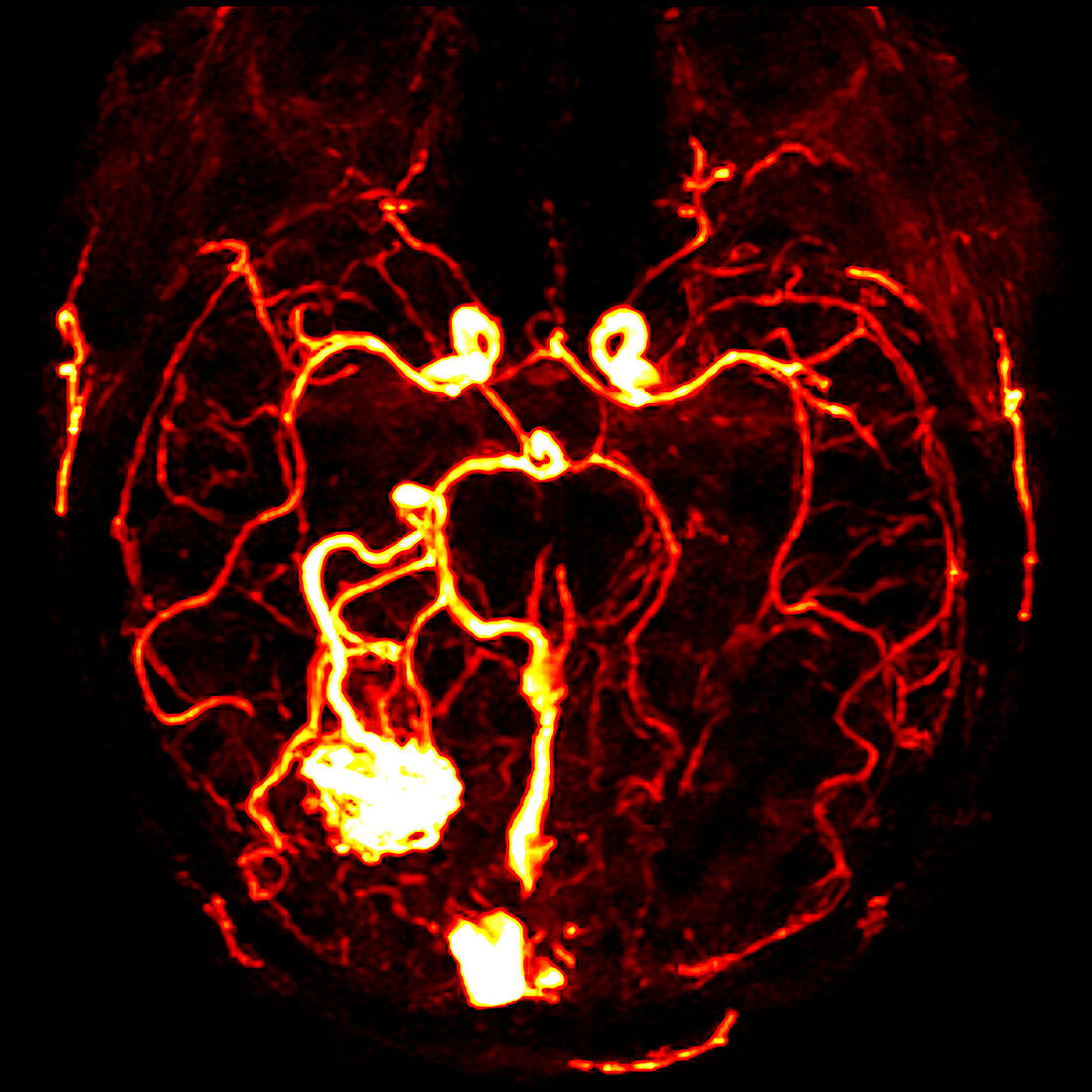 Arteriovenous malformation, CT scan