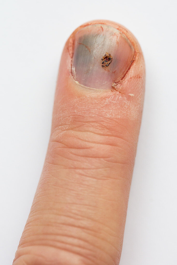Blackened fingernail