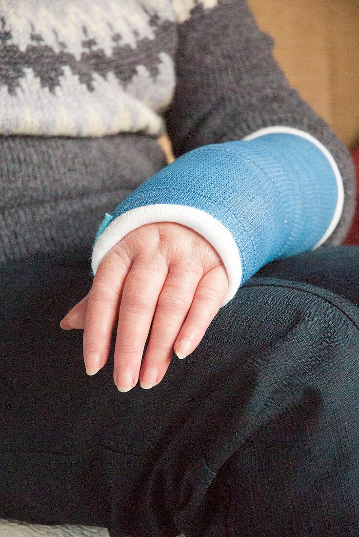 Cast on wrist with Colles' fracture