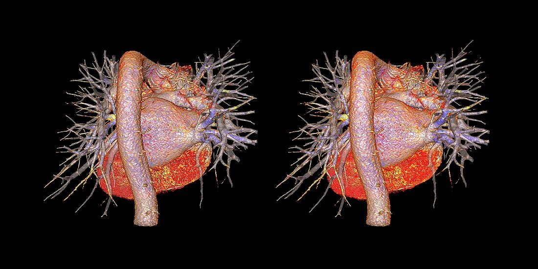 Heart and pulmonary blood vessels, CT stereograms