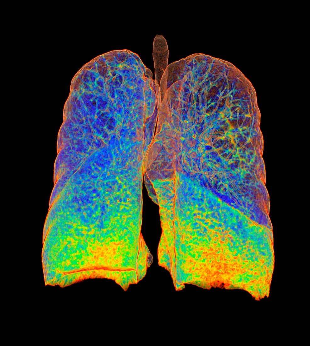 Smoker's lungs and emphysema, illustration