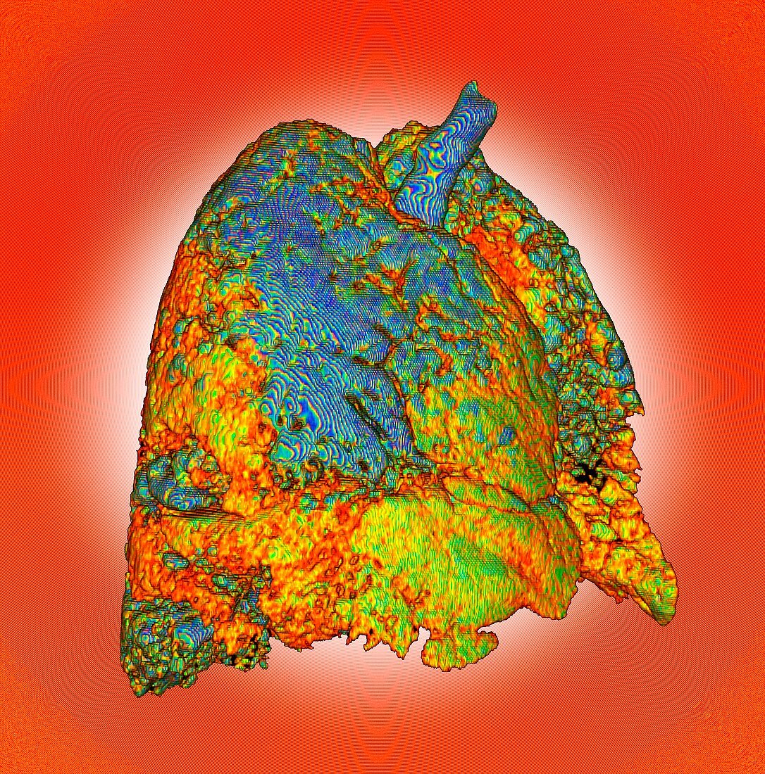 Interstitial lung disease, illustration