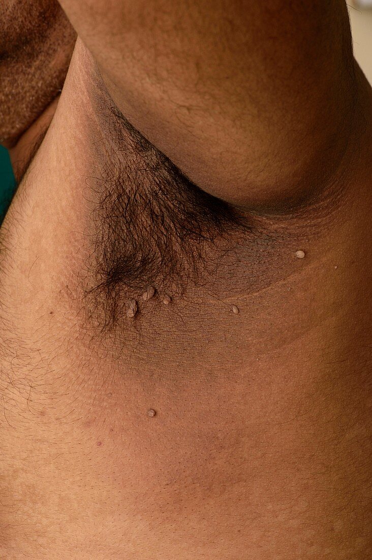 Acanthosis nigricans