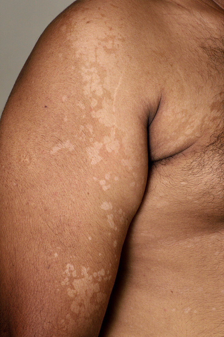 Pityriasis versicolor skin patches