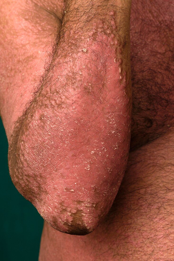 Psoriasis on the forearm