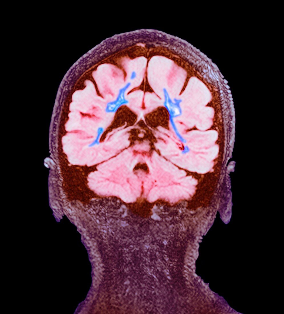 Multiple sclerosis, coronal brain MRI scan