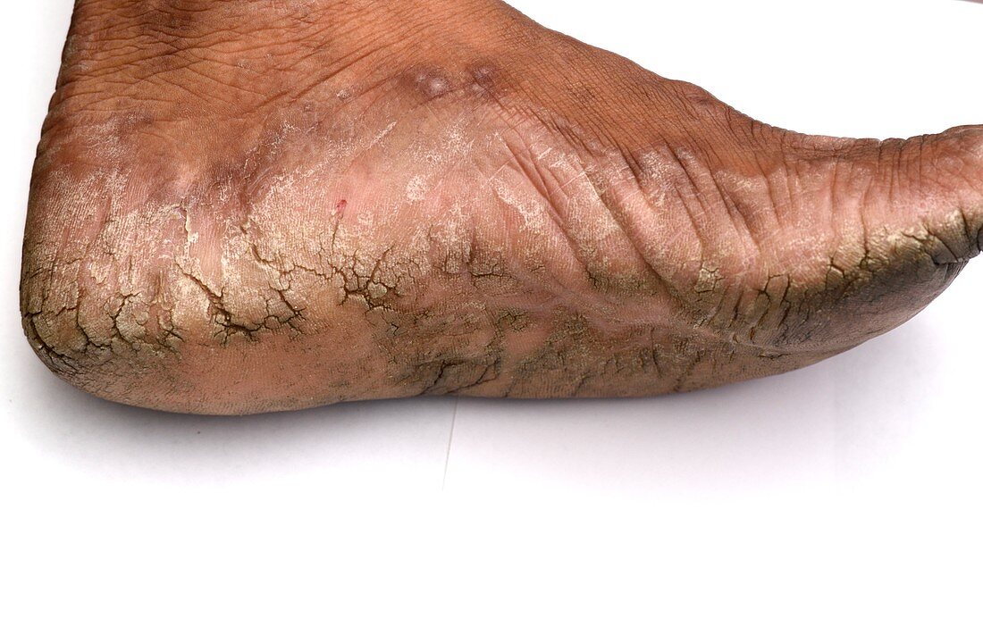 Hyperkeratosis of the foot