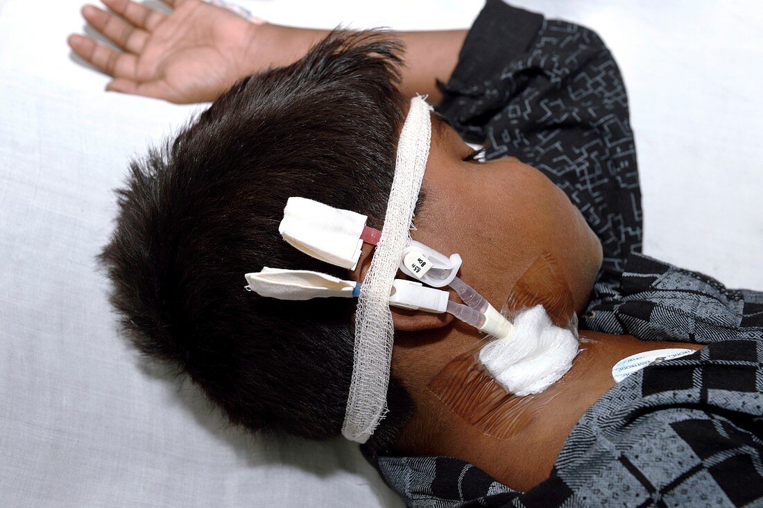 Child fitted with dialysis catheter