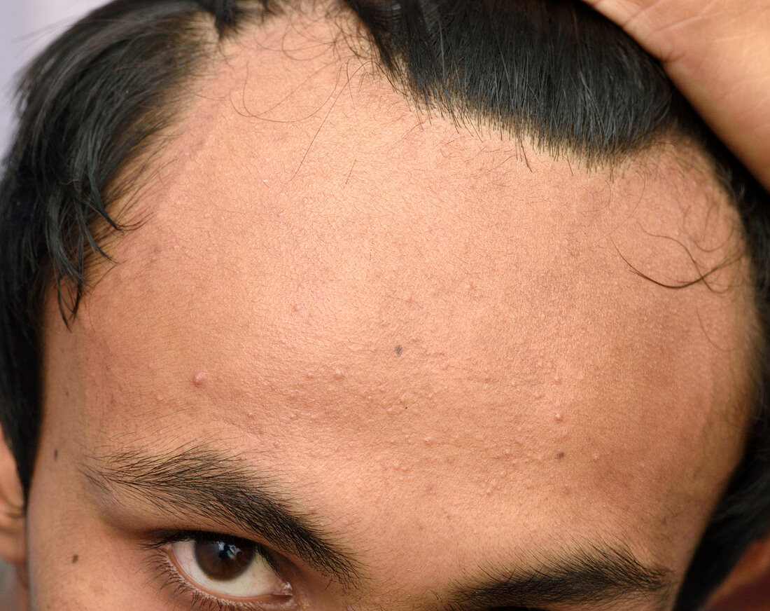 Male pattern baldness