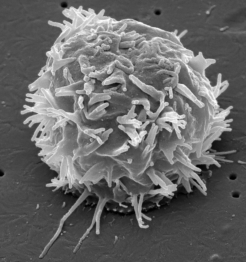 Breast cancer cell, SEM