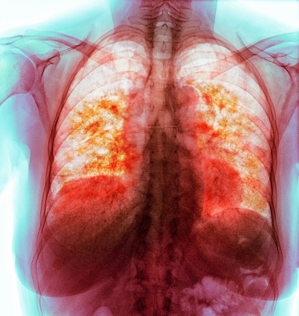 Pulmonary fibrosis, coloured x-ray