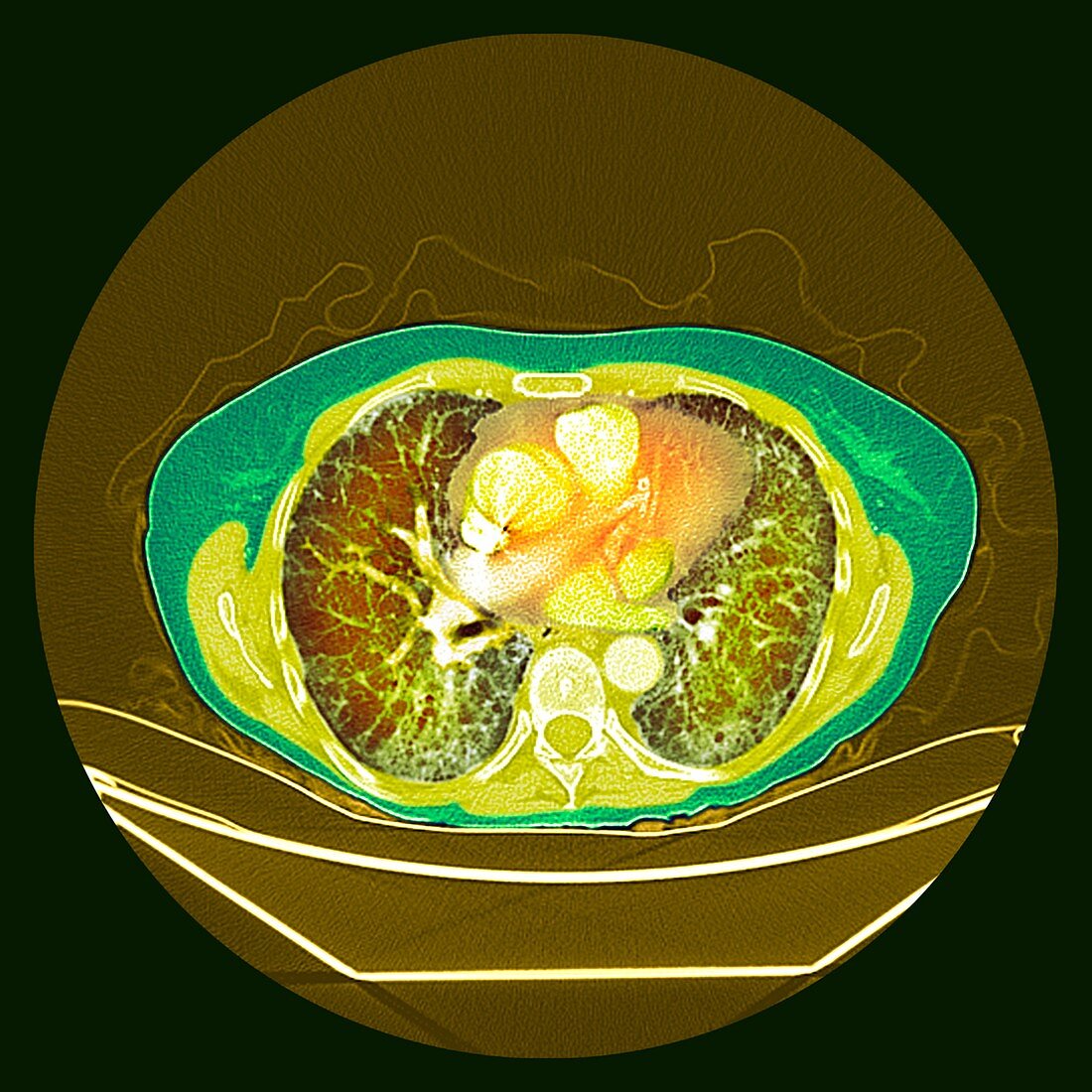 Pulmonary fibrosis, coloured CT scan
