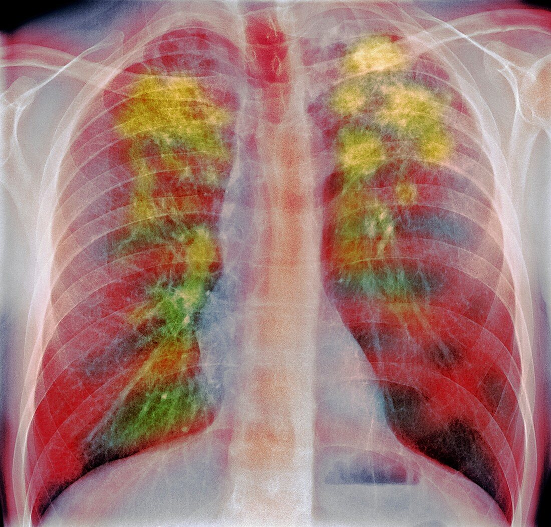 Pulmonary sarcoidosis, x-ray