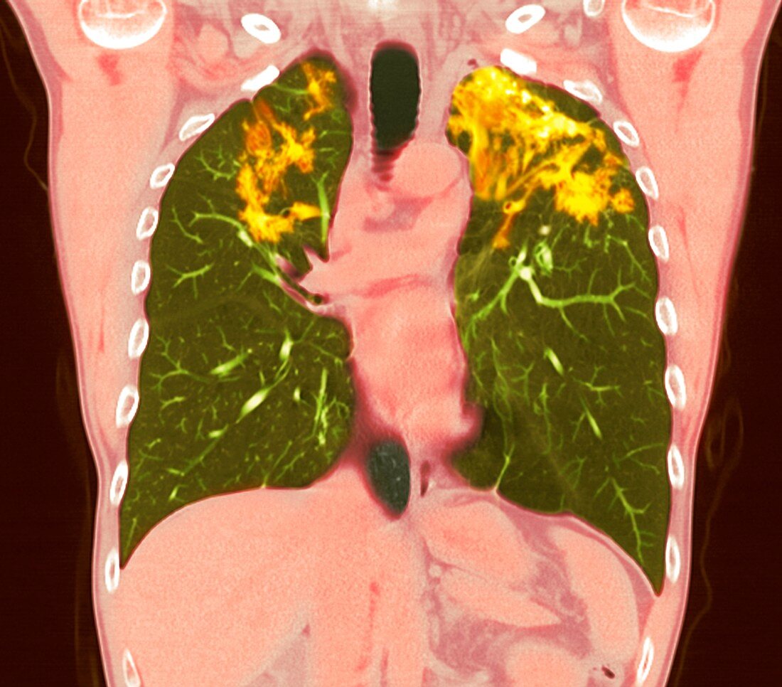 Pulmonary sarcoidosis, CT scan