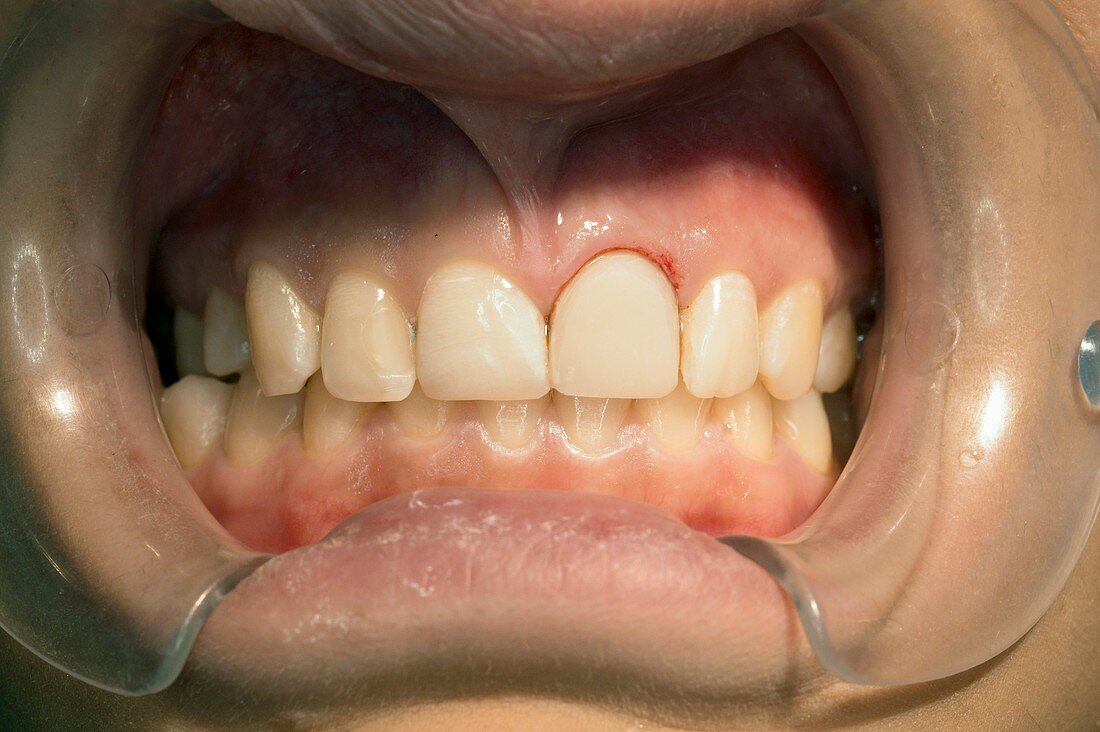 Cosmetic restoration of tooth
