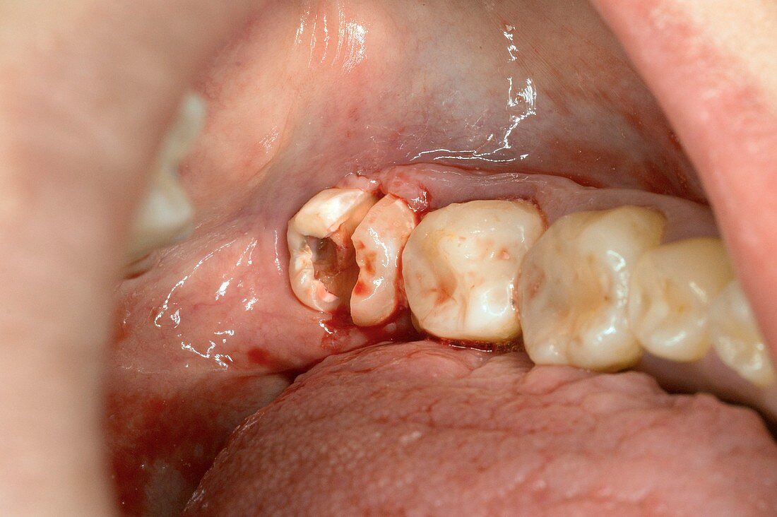 Wisdom tooth prepared for extraction