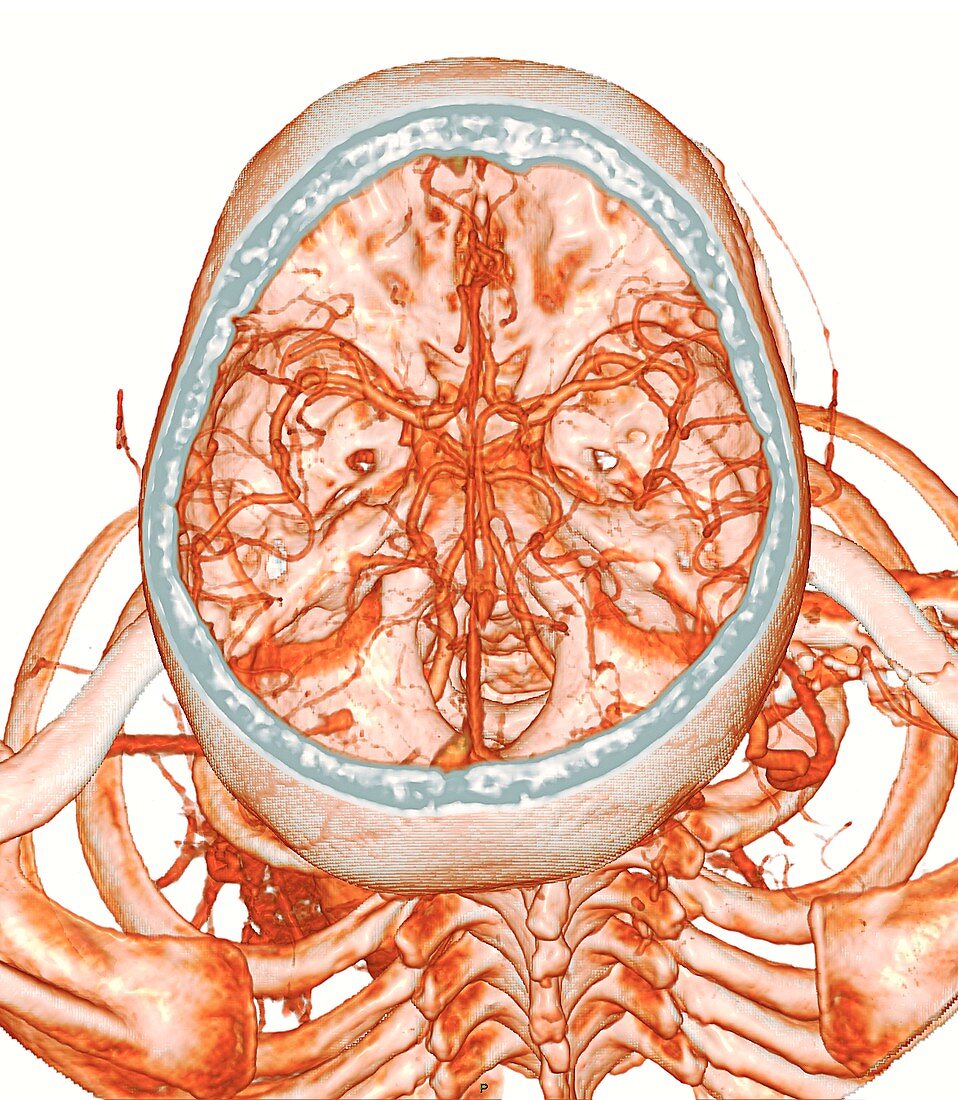 Intracranial blood vessels, 3D CT angiogram