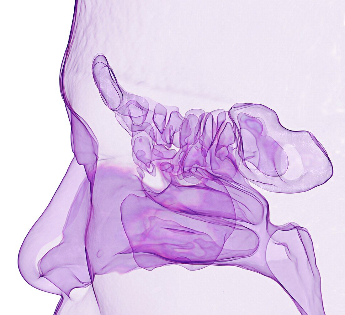 Paranasal sinuses and nose, 3D CT scan