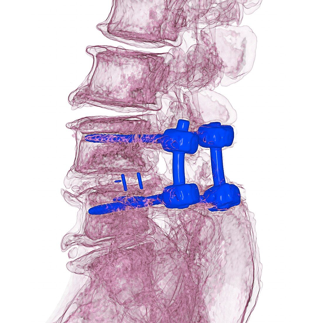 Spinal implant in lumbar fusion, 3D CT scan