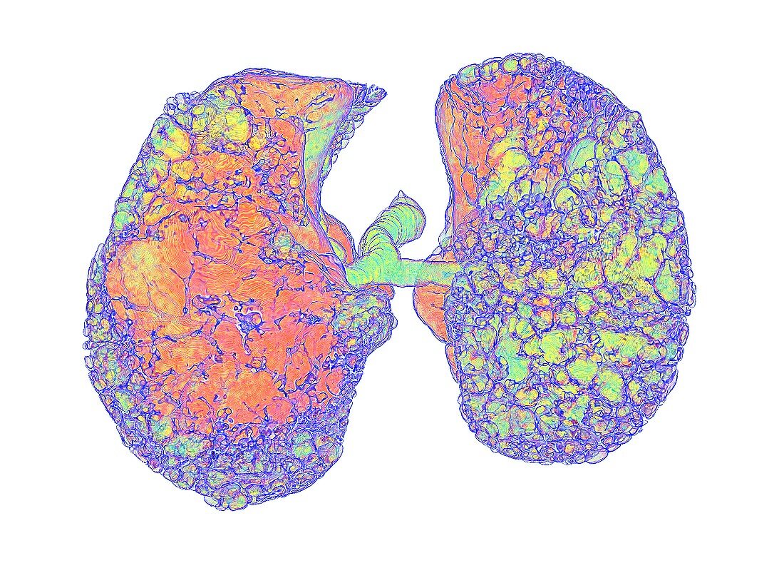 Usual interstitial pneumonia, 3D CT scan